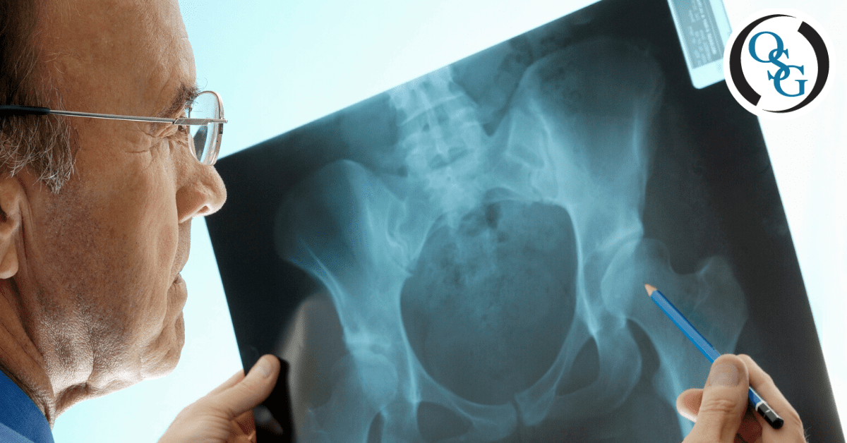 3 Signs You May Have Osteoarthritis in Your Hip: Orthopaedic