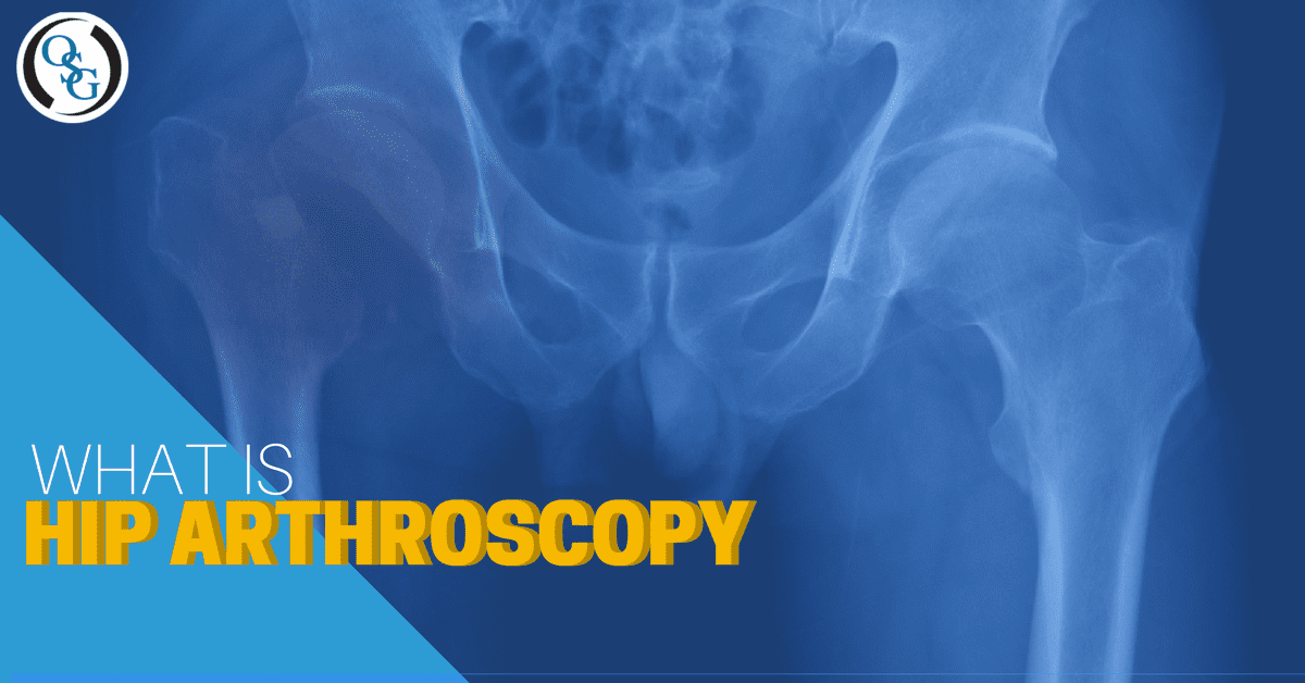 What Is Hip Arthroscopy & How Can It Help