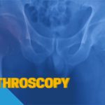 Hip Arthroscopy