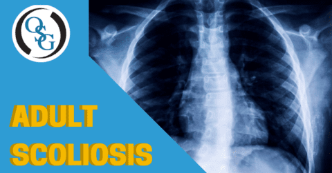What is adult scoliosis