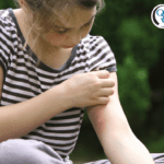 Girl scratching an irritated mosquito bite