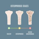 Osteoporosis process infographic of bone tissue close-up with different density. Skeletal system disease stages. Senior osteopathy medical concept. Vector illustration.